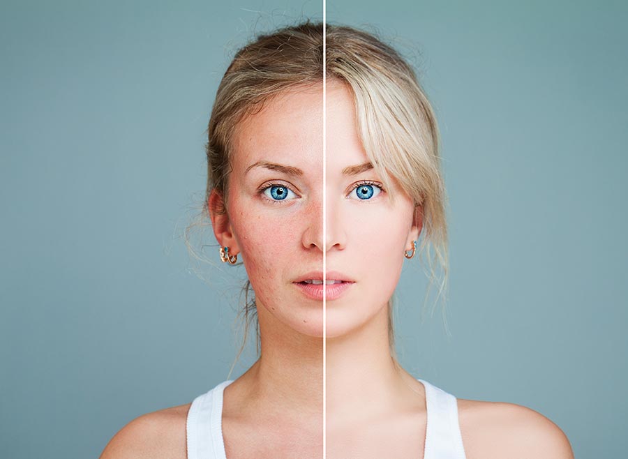 effects of acne treatments