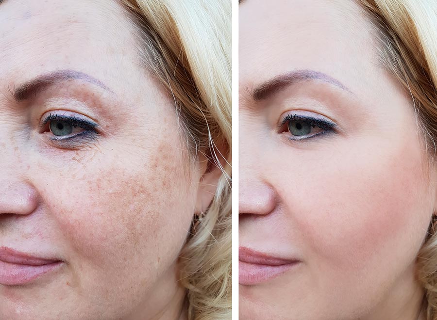 effects of pigmentation treatments